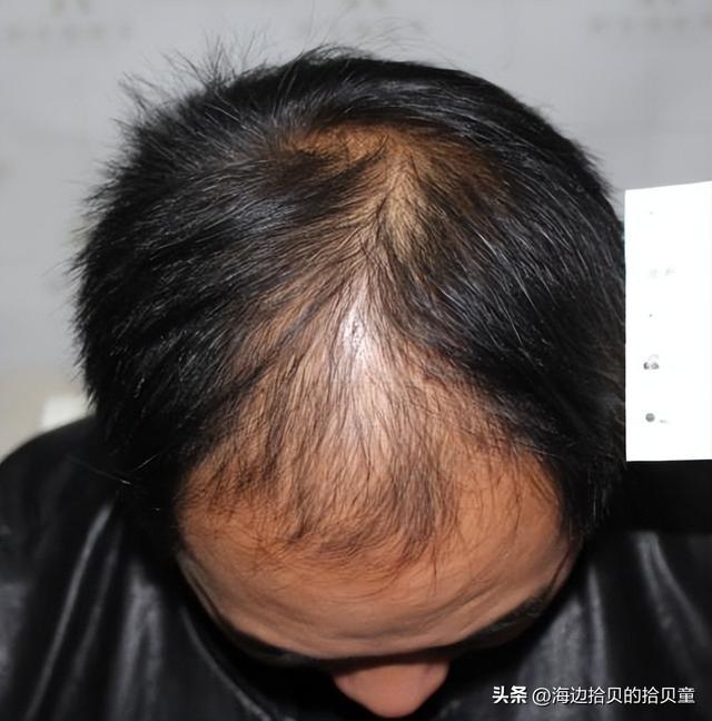 最好?育发液什么牌子最有效果?冰球突破游戏日本生发液哪个牌子(图2) 最好?育发液什么牌子最有效果?冰球突破游戏日本生发液哪个牌子(图2)